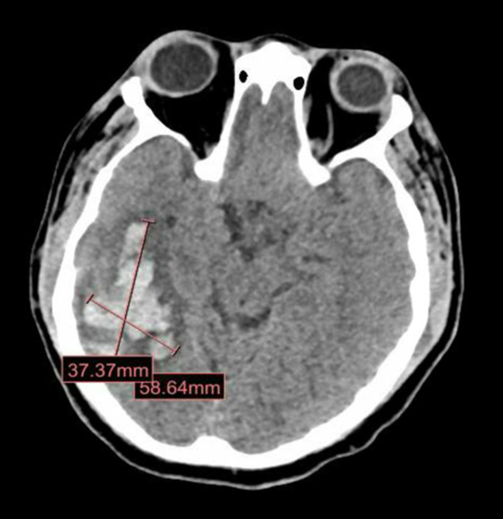 Brain Computed tomography (CT) scan on hospital day 9. Large hyperdense intracranial bleed in the right parietotemporal region with surrounding edema, measuring 5.8×3.7 cm.