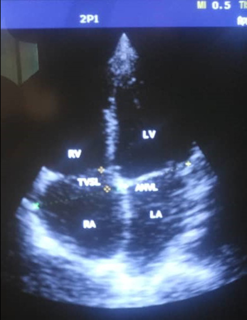 Displaced leaflets of tricuspid valve apically in apical 4-chamber view.