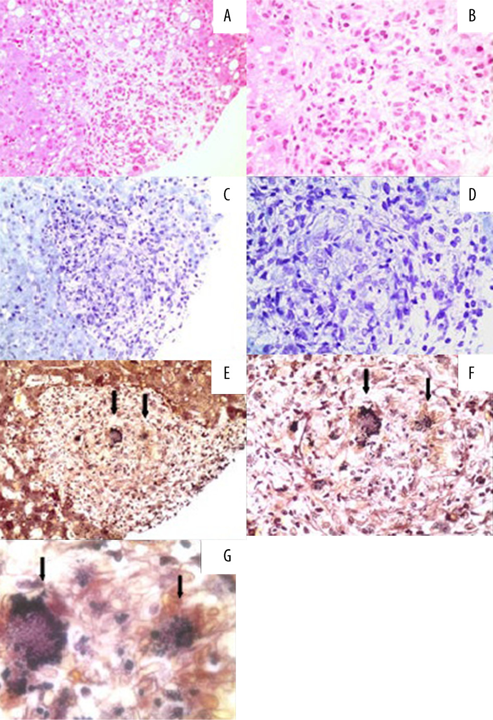 (A, B) Granulomatous inflammation in the liver, with the presence of clustered macrophages (H&E, 20 and 40×, magnification, respectively). (C, D) Absence of acid-fast bacilli in granulomas (Ziehl-Neelsen, 20 and 40×, magnification, respectively). (E–G) Presence of small rounded, birefringent, and clustered structures (Gomori-Methanamine-Silver, 20, 40 and 100×, magnification, respectively).