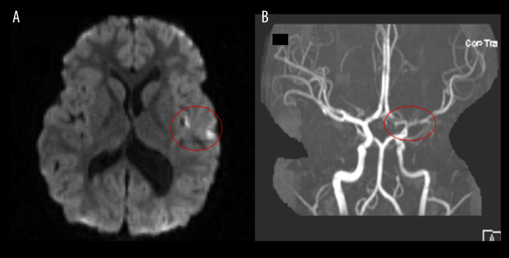 (A) Foci of acute infarct in the left frontal operculum. (B) Poor signal in the M1 segment of the left middle cerebral artery indicating severe stenosis and an acute cutoff of left inferior M2 division indicating occlusion.