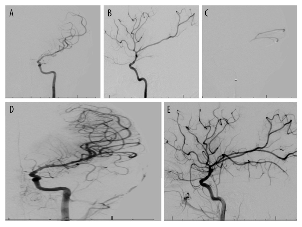 (A, B) Left internal carotid artery injection through the diagnostic catheter. There is an acute cutoff of inferior M2 division with corresponding oligemia. (C) The microcatheter injection confirms the position of the microcatheter beyond the occlusion of the vessel. (D, E) Post thrombectomy injection from Sophia intermediate catheter. The occluded inferior division M2 branch is now recanalized with antegrade flow and evidence of focal oligemia in the region of the angular gyrus, which is likely related to a small occluded branch.