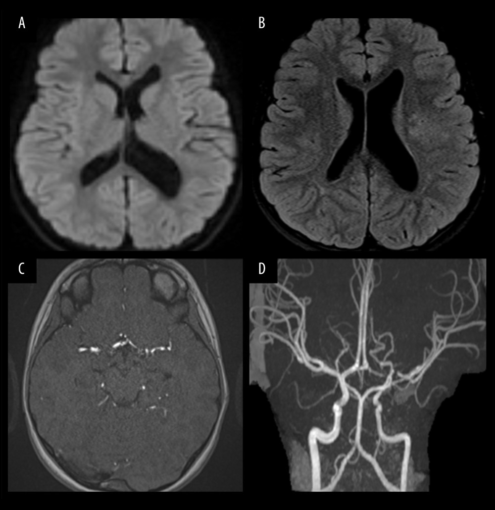 (A) Diffusion-weighted imaging with no new or acute infarcts. (B) Fluid-attenuated inversion recovery showing stable sequelae of prior left middle cerebral artery distribution infarct with multifocal small old lacunar infarcts. (C, D) Stable severe stenosis of the left M1 segment.