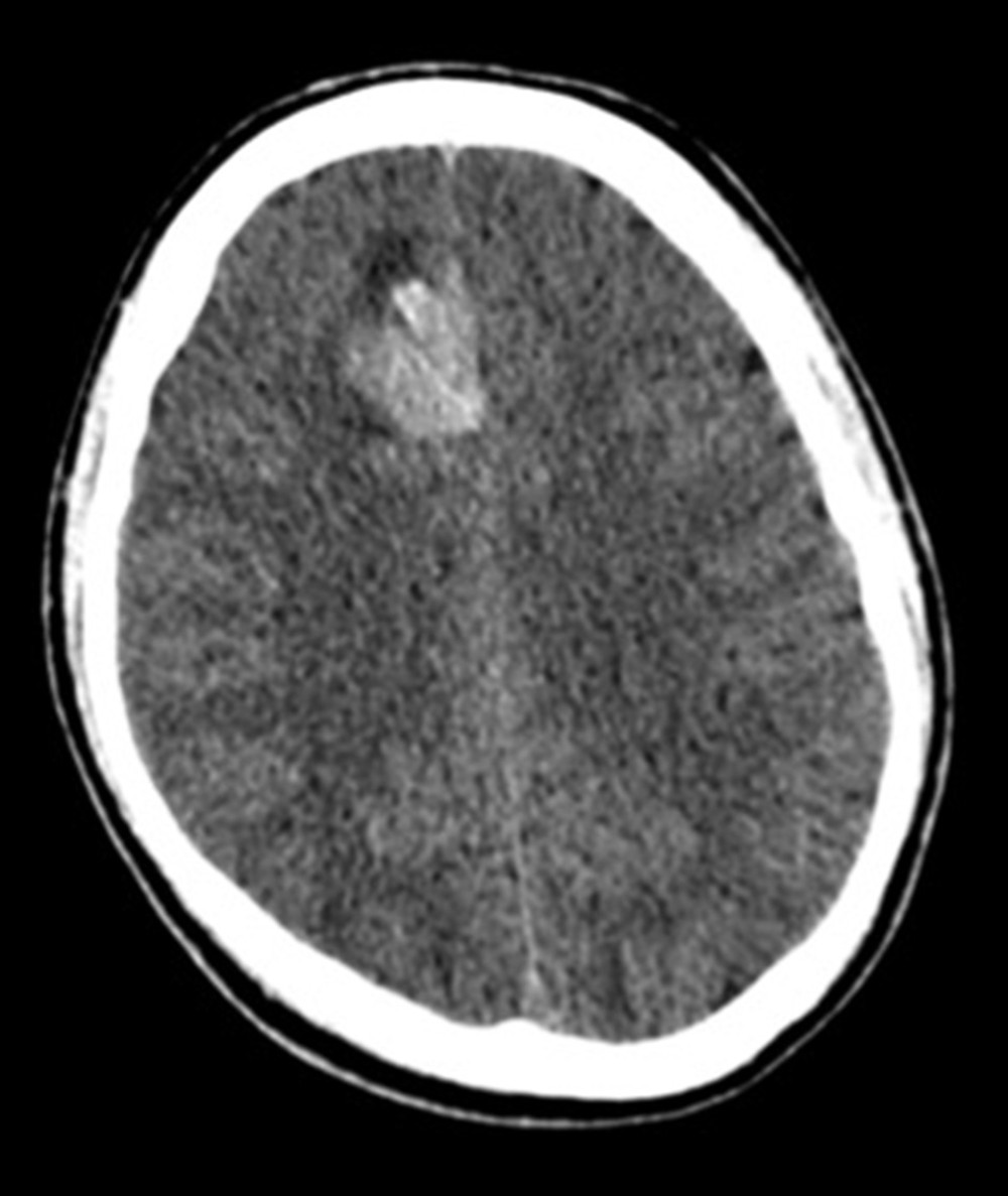 An axial computed tomography scan of the head without intravenous contrast shows a hyperdense right frontal parafalcine lesion with decreased attenuation in the periphery, suggestive of edema.