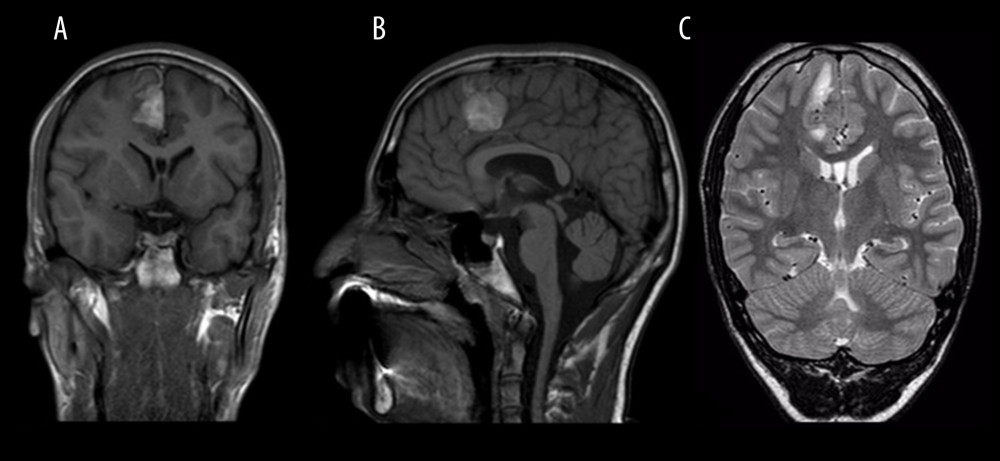 (A) Coronal and (B) sagittal non-contrast T1-weighted sequences show a right parafalcine T1 hyperintense lesion. (C) A coronal T2-weighted sequence shows a lesion that is isointense to gray matter with mild adjacent vasogenic edema.