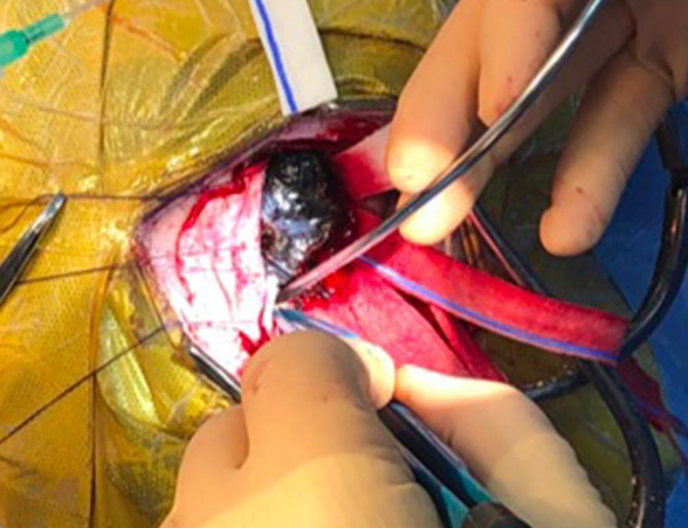 An intraoperative photograph taken during excision of the mass by a neurosurgeon shows a dark, firm, pigmented mass with a dural attachment, which was resected.