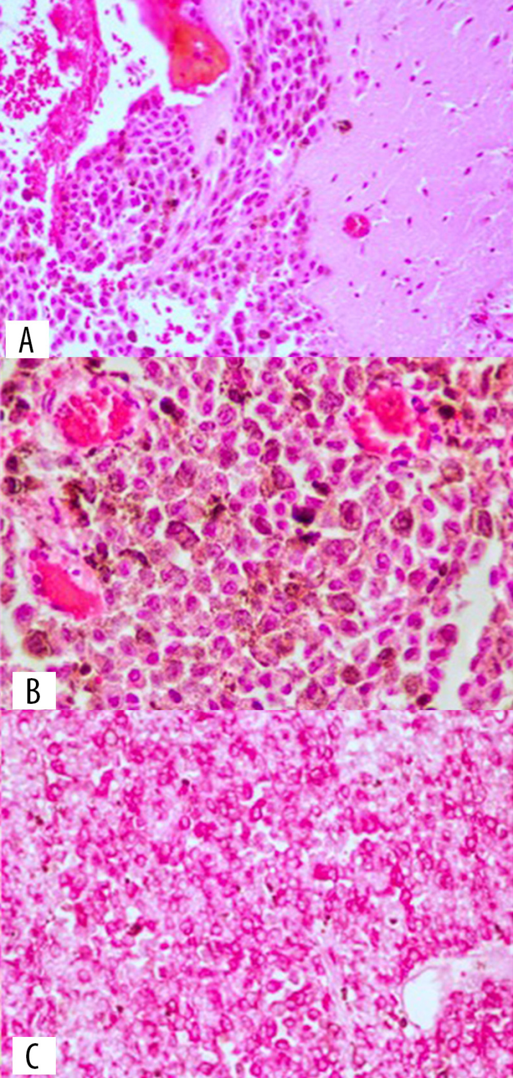 (A) Hematoxylin & eosin (H&E) staining (magnification 20×) shows nests of melanoma cells (left) next to normal brain tissue (right). (B) H&E staining (magnification 40×) shows sheets of malignant melanocytes with prominent eosinophilic nucleoli and dense melanin pigmentation. (C) Magnification (magnification 20×) shows a positive cytoplasmic immunoreaction to HMB45 (red chromophore).