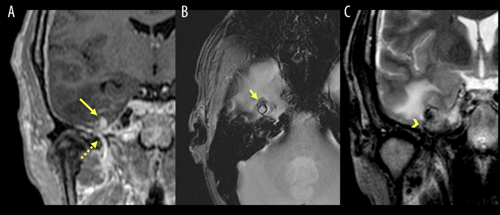 (A) Post-contrast 3D T1 in the coronal plane shows a hyper-enhancing lesion at the right middle cranial fossa (long arrow) adjacent to the right foramen spinosum. In this image, the MMA can be seen traversing the foramen spinosum (dashed arrow). (B) Gradient echo axial image shows a ring-like blooming artifact (short arrow) associated to this lesion. (C) Coronal T2W image demonstrates a tubular flow void (arrowhead) connecting the vascular lesion with the foramen spinosum.