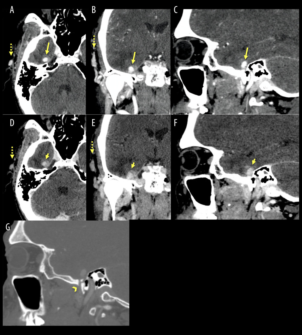 (A–C) CTA in axial, coronal, and sagittal planes shows a hyper-enhancing lesion (solid arrows) at the right middle cranial fossa. (D–F) Delayed CTA images (75 s after the standard CTA phase) show subsequent peripheral contrast pooling (short arrows) in keeping with a middle meningeal artery pseudoaneurysm. A craniofacial hemangioma is also seen superficial to the right temporal bone (dashed arrows in A, B, D and E). (G) Sagittal CTA in the bone window better demonstrates the relationship between the right middle cranial fossa pseudoaneurysm and the foramen spinosum (arrowhead).