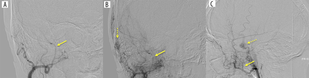 (A) Frontal oblique arterial, (B) early venous, and (C) lateral oblique arterial digital subtraction angiography with selective injection of the right external carotid artery fail to demonstrate a pseudoaneurysm along the course of the middle meningeal artery (solid arrow). Multiple craniofacial hemangiomas are noted at the right orbit (not shown), masticator space (not shown) and superficial temporal region (dashed arrow) feeding from right ECA branches.