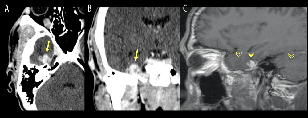 (A, B) Three-month follow-up CTA in axial and coronal planes shows interval progression in size and change in configuration of the right middle cranial fossa MMAP (solid arrows). (C) Post-contrast T1 in the sagittal plane shows the right-sided MMAP (solid arrowhead) with a subtle pulsation artifact in the phase-encoding direction (empty arrowheads).
