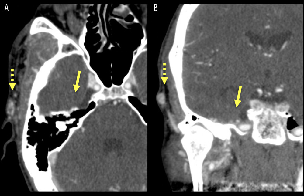 (A, B) Ten-month follow-up CTA in axial and coronal planes shows complete resolution of the previously identified right-sided MMAP at the right middle cranial fossa (solid arrow). The craniofacial hemangioma is still seen superficial to the temporal bone (dashed arrow).