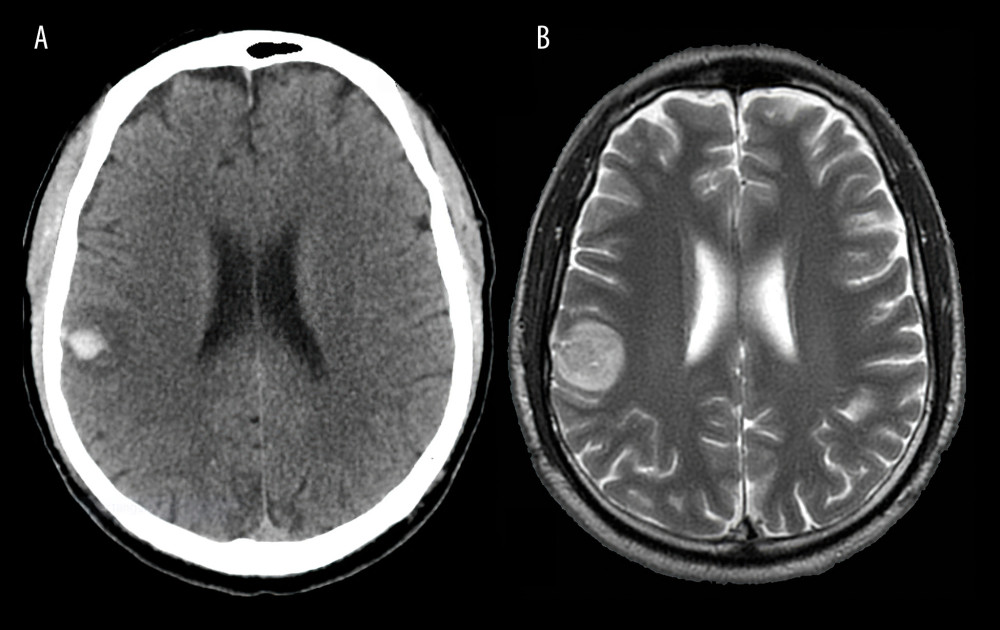 The computerized tomography scan of the head on the left (A) shows the intracerebral hemorrhage as a small round area of increased signal intensity. It is surrounded by a halo of lower signal intensity, representing surrounding edema. The initial T2-sequence magnetic resonance imaging, on the right (B), performed 4 h later, shows that the hematoma has increased in size.