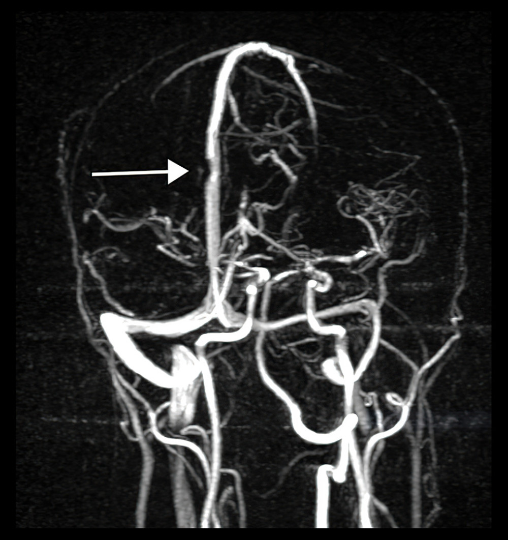 Initial magnetic resonance venogram of the brain, showing a right filling defect within the superior sagittal sinus. This was due to a thrombus within the sinus, at the site of thrombosed cortical vein. It correlates well with the computed tomography scan in Figure 1.