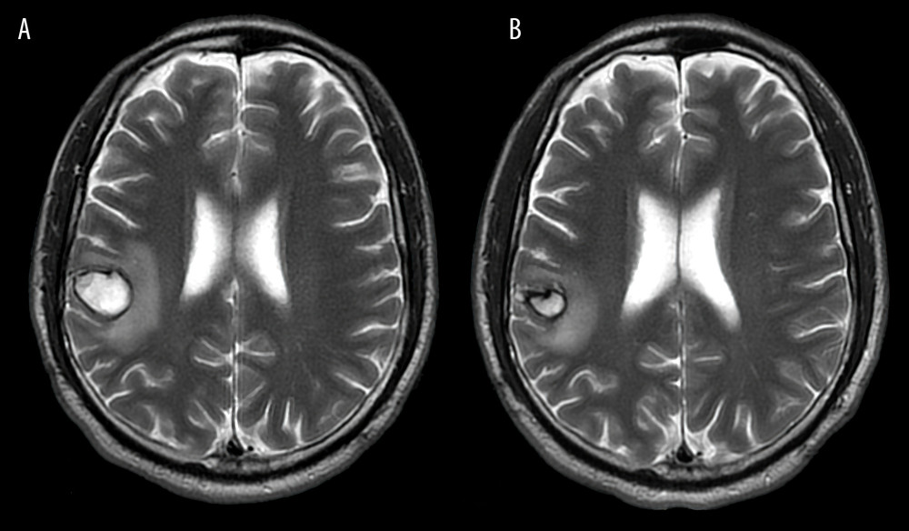 Follow-up images performed at (A) 7 weeks and (B) 12 weeks after the stroke. These are T2-sequences of magnetic resonance images. Note the time-related decrease in size and signal intensity of the hematoma, as well as the amount of surrounding edema.