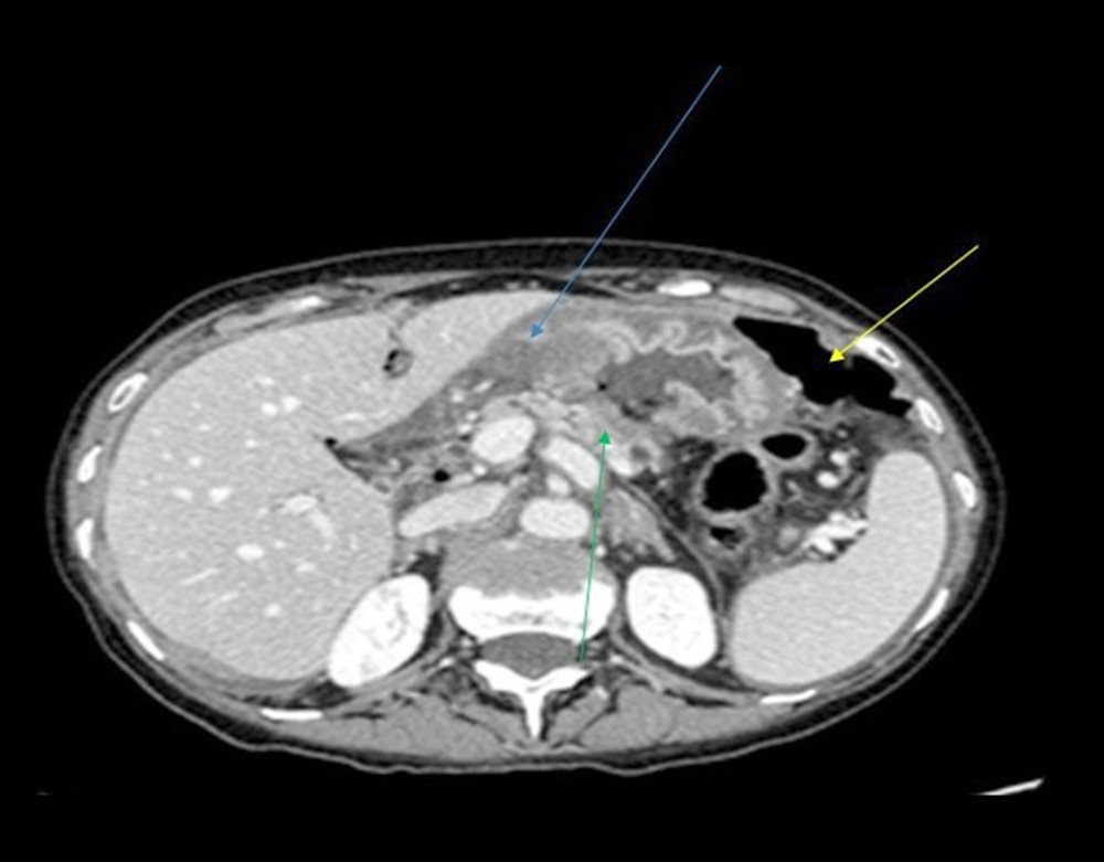 Axial image from an abdominal computed tomography (CT) scan in a 58-year-old Lebanese woman who presented with acute gastric perforation due to metastatic ductal carcinoma 18 years following bilateral mastectomy. The yellow arrow shows pneumoperitoneum. The green arrow shows tumor in the pancreas. The blue arrow shows an area of fluid associated with gastric perforation.