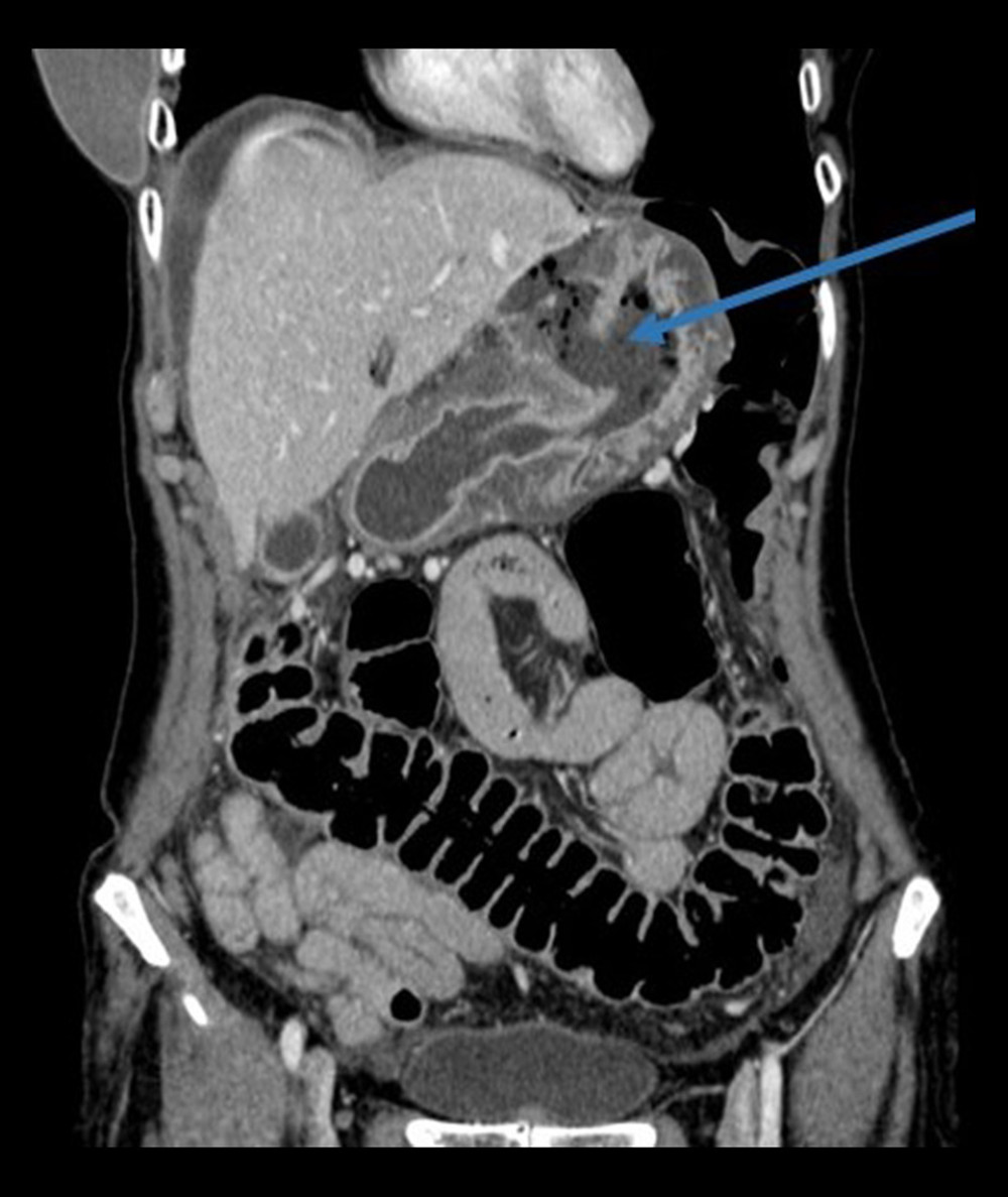 Coronal image from an abdominal computed tomography (CT) scan in a 58-year-old Lebanese woman who presented with acute gastric perforation due to metastatic ductal carcinoma 18 years following bilateral mastectomy. The arrow shows the site of gastric perforation.