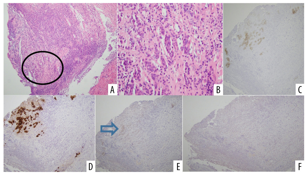 Photomicrographs showing histopathology and immunohistochemistry of the surgical resection specimen from a 58-year-old Lebanese woman who presented with acute gastric perforation due to metastatic ductal carcinoma 18 years following bilateral mastectomy. (A) Low-power image showing a cellular tumor replacing normal gastric mucosa and gastric wall. Hematoxylin and eosin (H&E); magnification ×10. (B) High-power image showing small cells with dark pink cytoplasm, arranged in small groups, consistent with the diagnosis of ductal carcinoma of the breast. H&E, magnification ×40. (C) Immunohistochemistry for human epidermal growth factor receptor 2 (HER2) showing that the tumor cells are HER2-negative. Magnification ×10. (D) Immunohistochemistry showing that the tumor cells are positive for cytokeratin 7 (CK7) (brown). Magnification ×10. (E) Immunohistochemistry showing that the tumor cells are positive for GATA3 (brown arrow). Magnification ×10. (F) Immunohistochemistry showing that the tumor cells are HER2-negative. Magnification ×10.