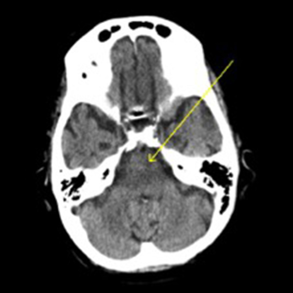 Computed tomography at initial presentation showing subacute infarct of the left pons indicated by the yellow arrow.