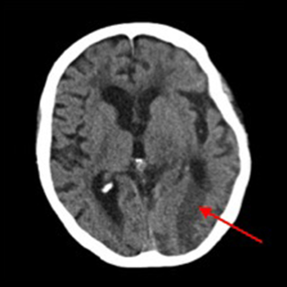 Repeat computed tomography showing acute to subacute infarct with encephalomalacia involving the left occipital lobe indicated by the red arrow.