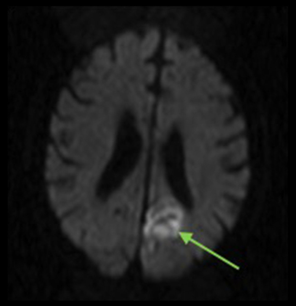 Magnetic resonance imaging revealing an area of ischemia supplied by the posterior cerebral artery indicated by the green arrow.