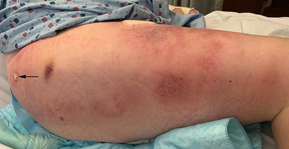 The right upper thigh revealed several discrete areas of induration with overlying warmth and erythema, including an ulcer at the superior lateral thigh.