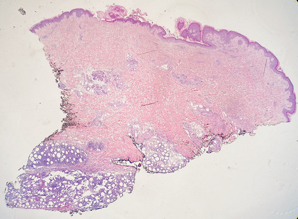 Excisional biopsy showing subcutaneous panniculitis-like T cell lymphoma involving the fat lobules with sparing of the overlying cutaneous tissue (×20, hematoxylin and eosin stain).
