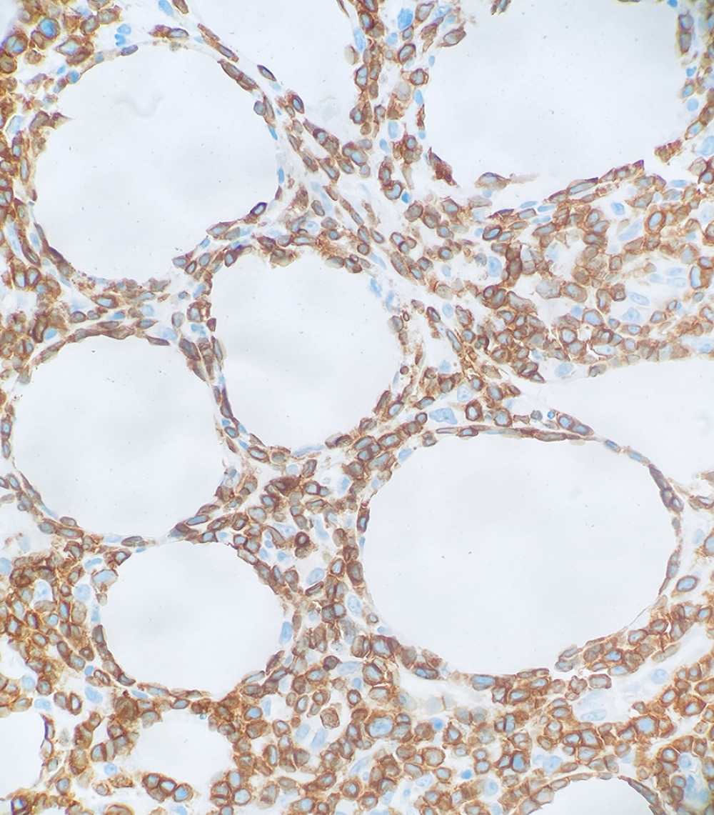 CD3 immunohistochemical stain of the atypical lymphocytes with hyperchromic nuclei in a membranous distribution, demonstrating T cell lineage (×400).