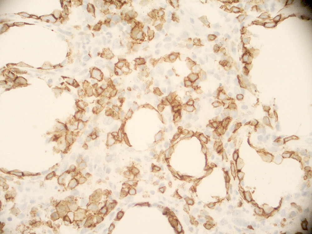 CD8 immunohistochemical stain highlights the atypical lymphocytes with hyperchromic nuclei in a membranous distribution, also demonstrating T cell lineage (×400).