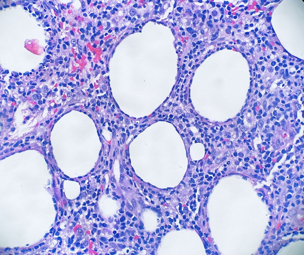 Rimming of the adipocytes by lymphocytes with nuclear atypia (×400, hematoxylin and eosin stain).
