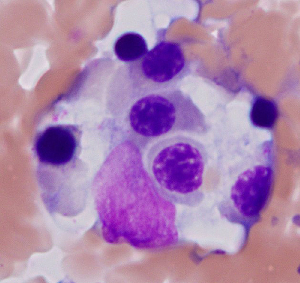 Histiocyte with phagocytosed erythroid precursors (Wright stain, ×100 magnification).