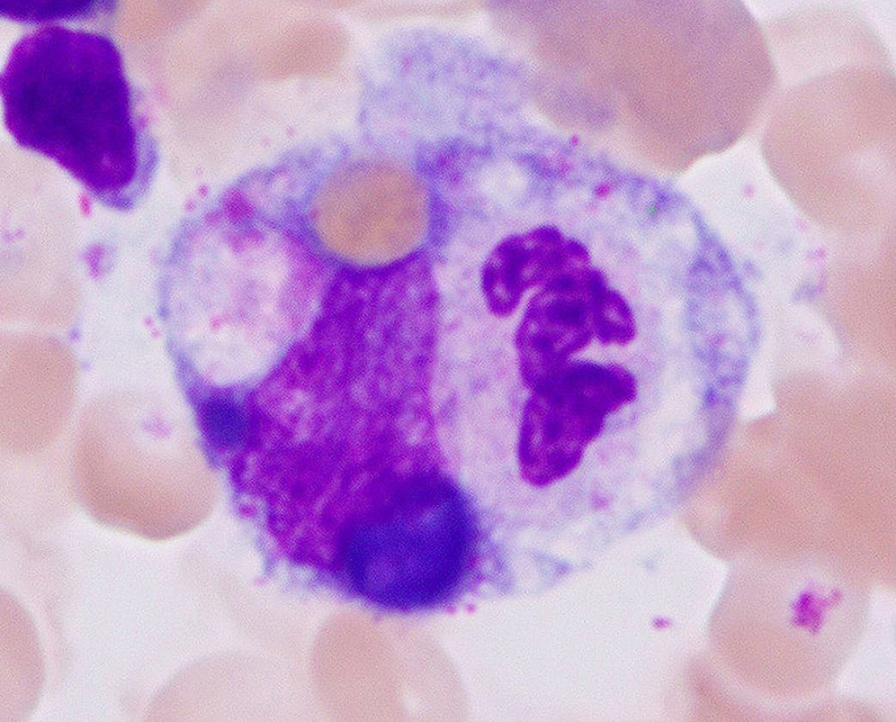 Histiocyte with phagocytosed neutrophil (Wright stain, ×100 magnification).