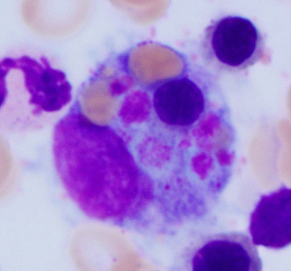 Histiocyte with phagocytosed erythroid precursor and platelets (Wright stain, ×100 magnification).