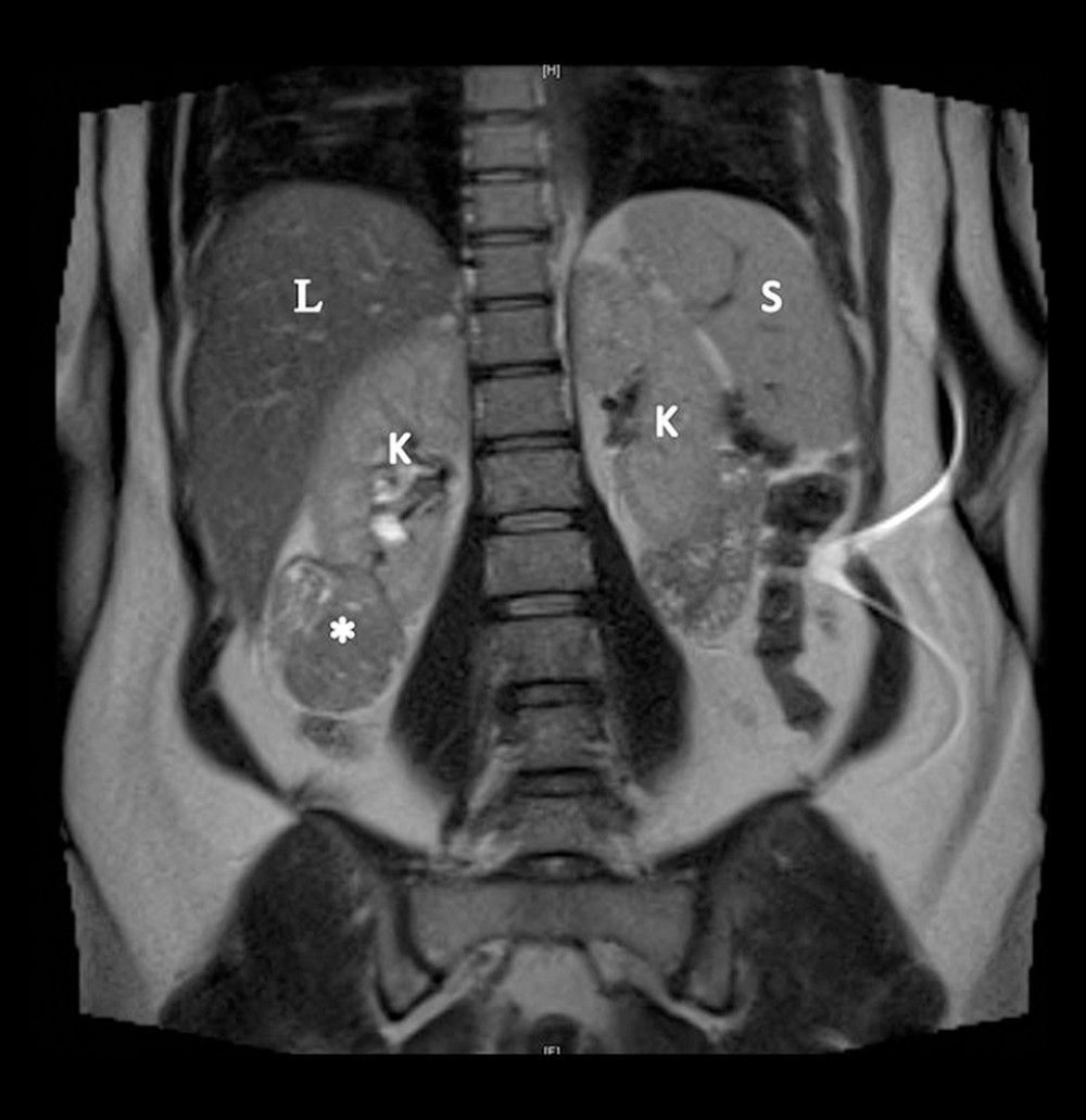 Magnetic resonance image (MRI) axial section of the abdomen in a 27-year-old woman at 30 weeks of gestation. MRI shows a 6×4 cm tumor in the lower pole of the right kidney. * – tumor; K – kidney; S – spleen; L – liver.