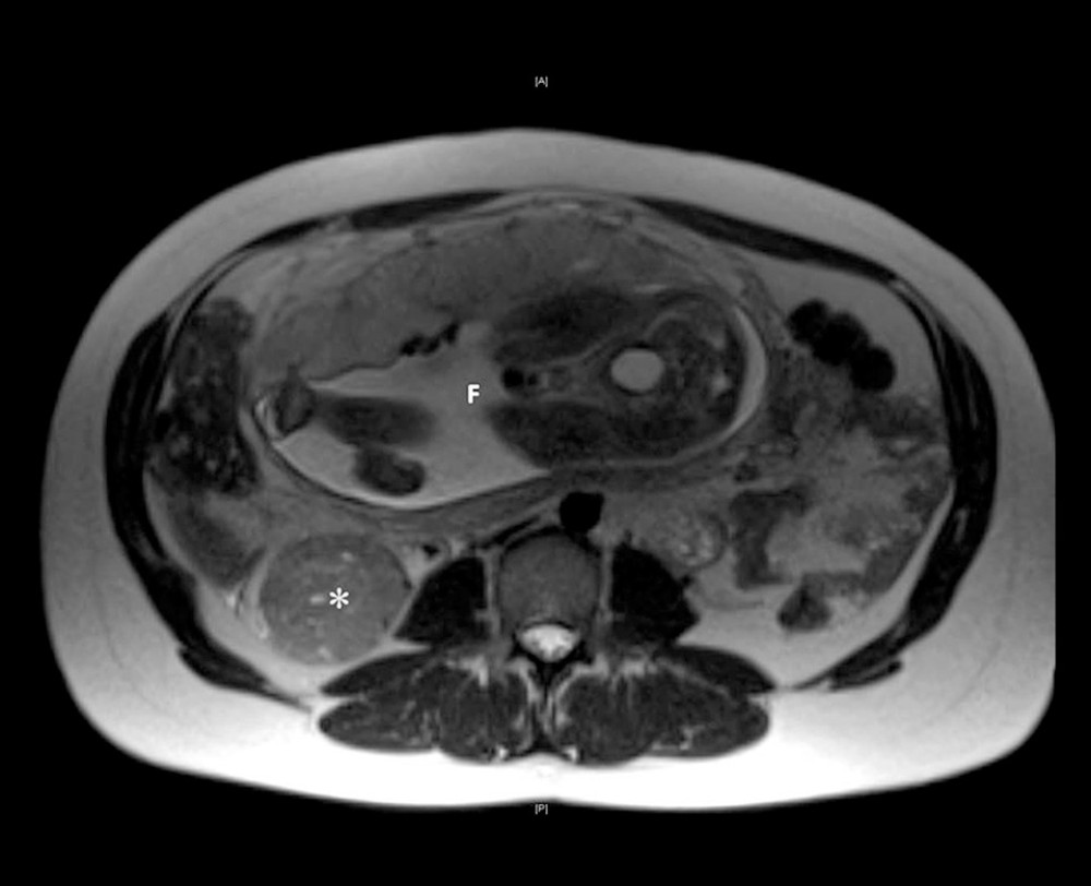 Magnetic resonance image (MRI) of the abdomen in a 27-year-old woman at 30 weeks of gestation. MRI-sagittal section shows a 6×4 cm tumor in the lower pole of the right kidney. * – tumor; F – fetus.