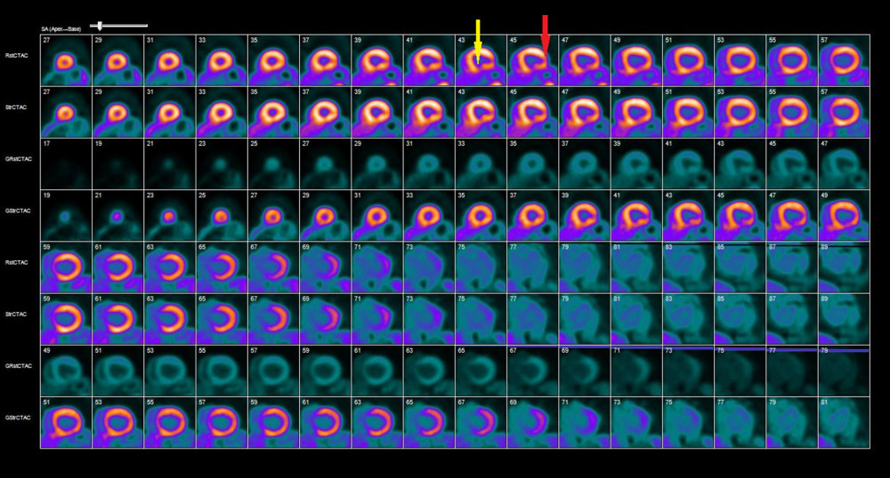 Pharmacologic stress/rest rubidium PET myocardium perfusion image showed 2 focal areas of round hypoperfusion in the mid-inferior (yellow arrow) and mid-lateral (red arrow) regions of the left ventricular myocardium.