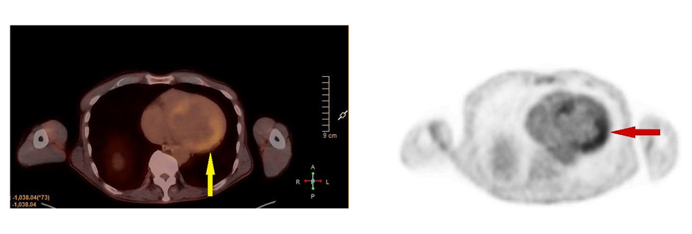 The 18F-fluorodeoxyglucose PET/CT scan showed a focal area of increased metabolic activity in the mid-inferior (yellow arrow) and mid-lateral (red arrow) regions of the left ventricular myocardium, corresponding to the areas of decreased perfusion noted on the rubidium perfusion study.