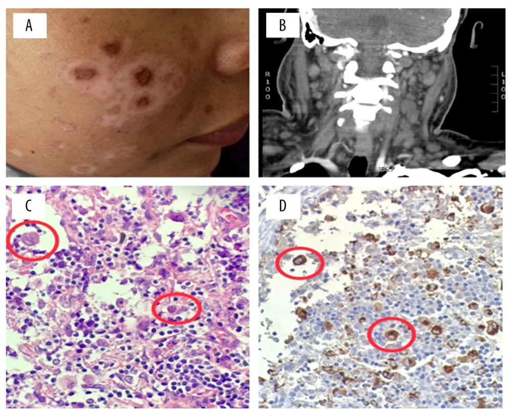 (A) Discoid lesions: well-defined, healing plaques with depressed central scars, atrophy, and hypopigmentation. (B) Coronal computed tomography scan shows cervical lymph nodes. (C) Hematoxylin and eosin staining (40×) of cervical lymph node biopsy shows plasmacytoid histiocytes with nucleus displaced to the periphery that alternates with mature lipocytes. (D) Immunostaining with avidin-biotin-immunoperoxidase technique (40×). The histiocytes are positive for the CD68 antigen, where the cytoplasm is dyed brown.