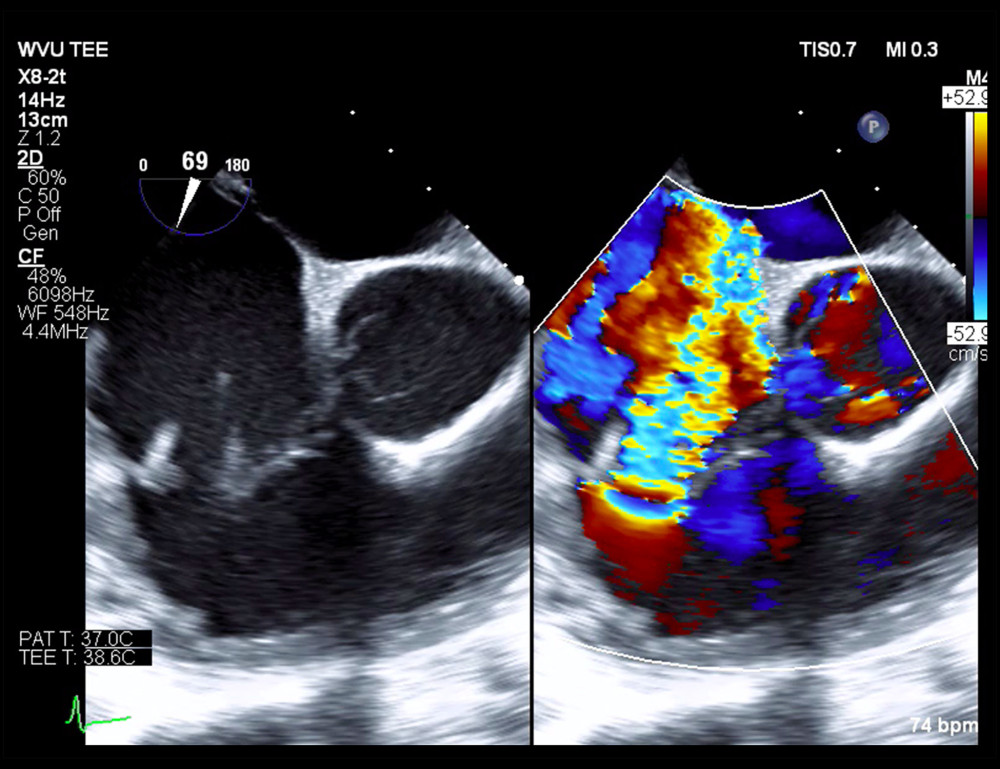 Intraoperative transesophageal echocardiogram, midesophageal 4-chamber view, initial operation September 2018.