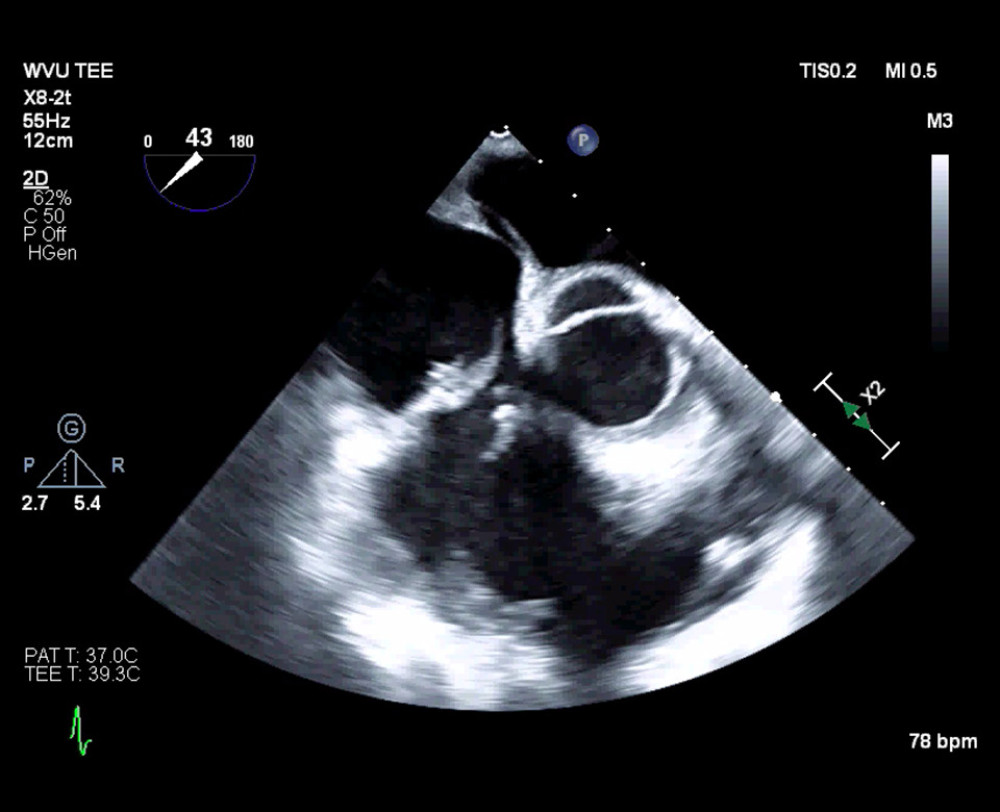 Intraoperative transesophageal echocardiogram, midesophageal 4-chamber view, second operation January 2019.