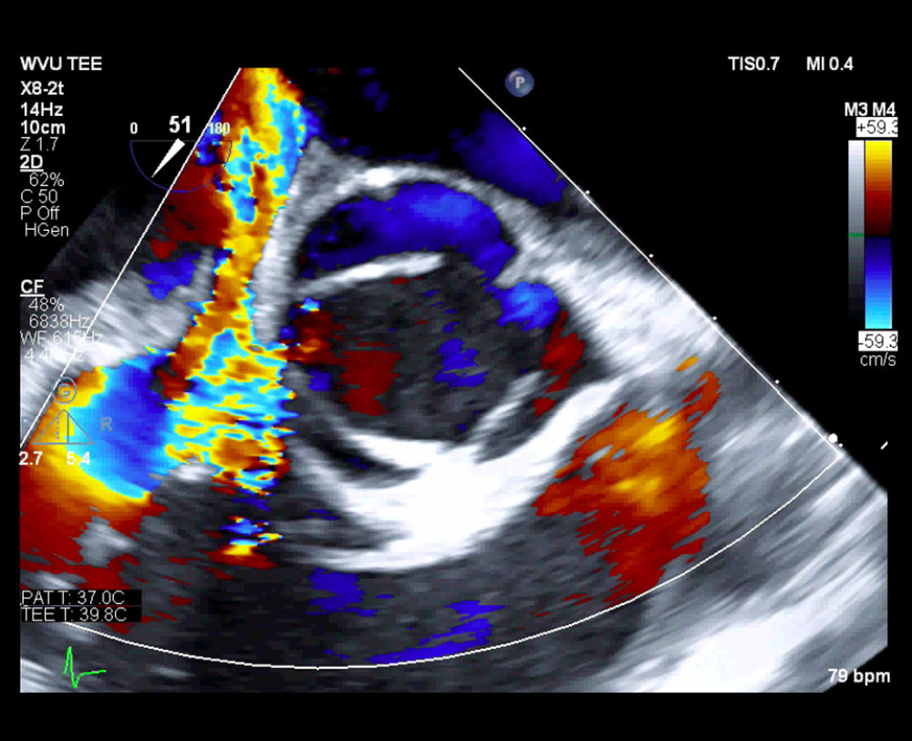 Intraoperative transesophageal echocardiogram, midesophageal 4-chamber view third operation March 2019.