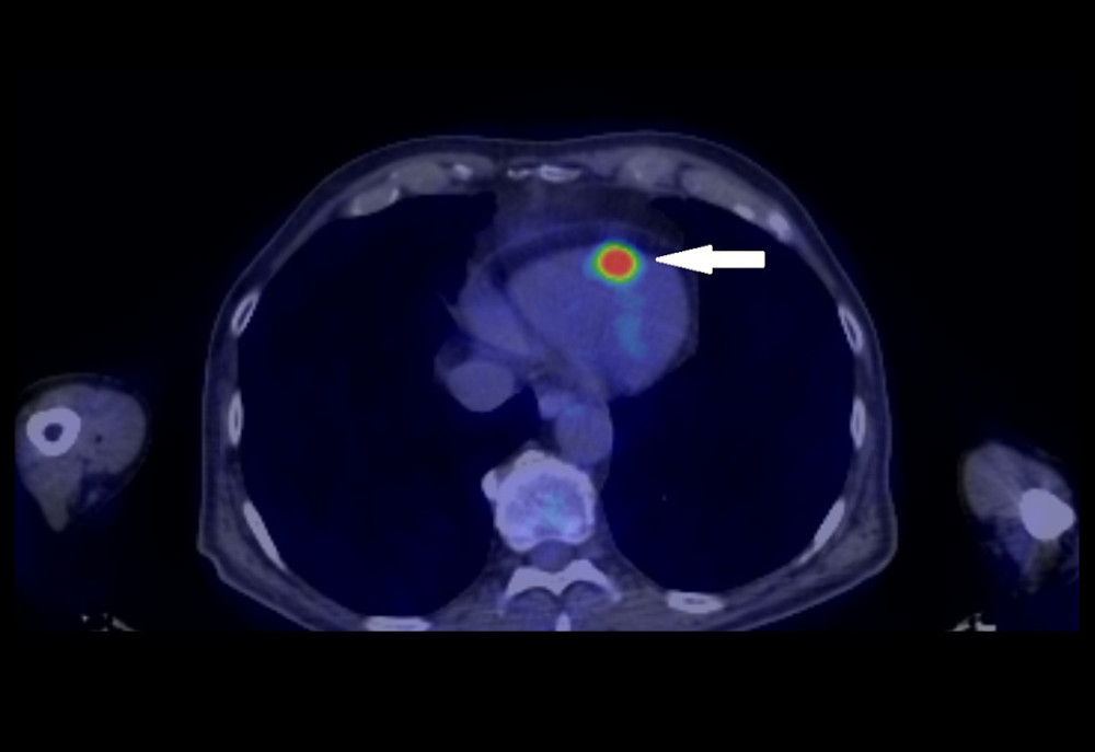Computed tomography-positron emission tomography scan. A hypermetabolic signal is visible near the apex of the right ventricle (arrow), showing a high standardized uptake value (maximum 15.1).