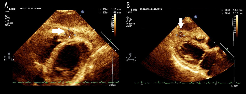 First transthoracic echocardiography. Two different (a and b) zoomed subcostal views of an intramyocardial mass (arrow) with a maximum diameter of approximately 1.6 cm.