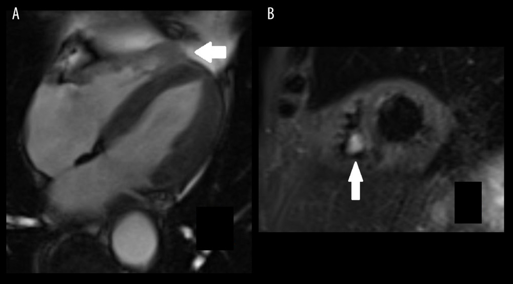 First magnetic resonance imaging scan. (A) Four-chamber steady-state free precession and (B) short-axis T2 short tau inversion recovery, showing a 17-mm round-shaped mass (arrow) that is hardly distinguishable from the right ventricular wall.