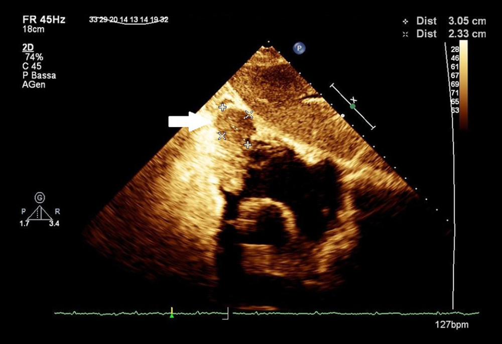 Control transthoracic echocardiography. After 14 days, the mass (arrow) showed a significant increase in linear dimensions with a maximum diameter of approximately 3 cm.