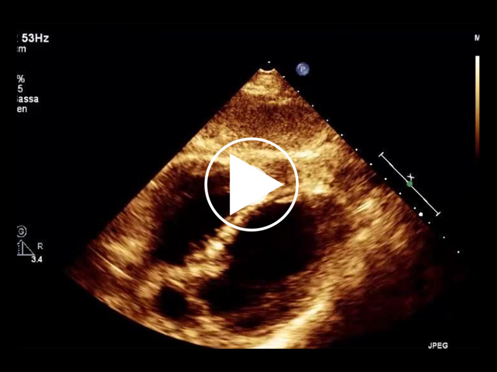 First transthoracic echocardiography: subcostal view showing the intramyocardial mass near the right ventricle apex.