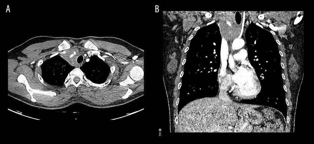 CT scan chest images. (A) Axial image showing superior mediastinal mass. (B) Coronal image showing right paratracheal mass extending to the thoracic inlet.