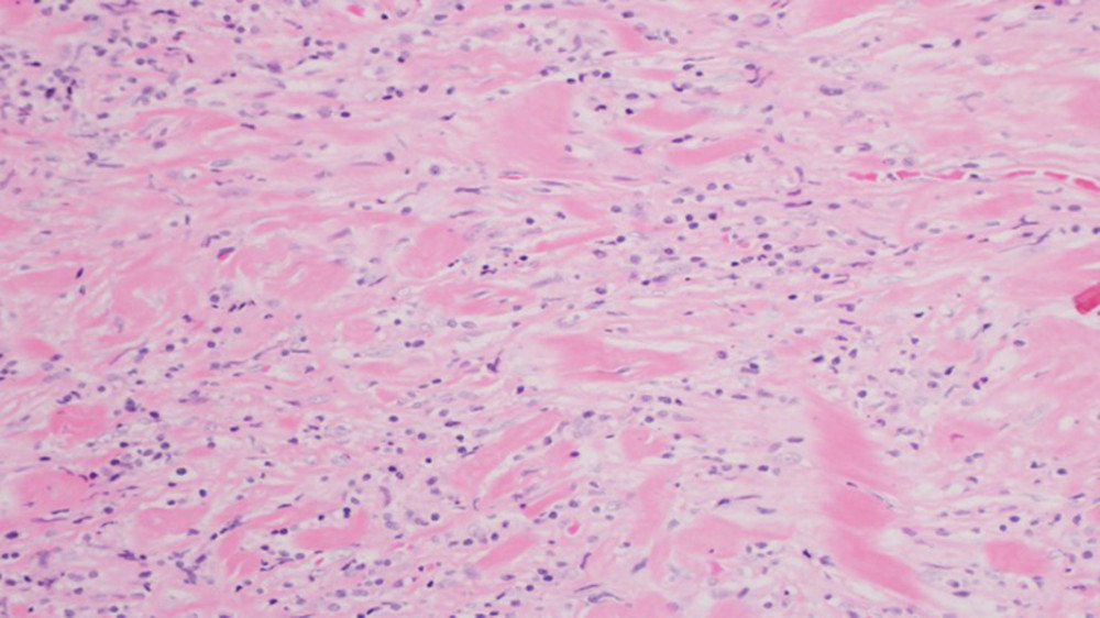 Mediastinoscopy biopsy of mass showing dense, fibrohyaline tissue with focal spindle and inflammatory cells (H&E stain ×100).