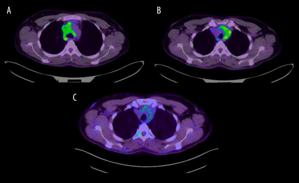 (A, B) PET scan images showing FDG uptake of the paratracheal mass. (C) PET scan image showing decreased FDG activity and regression of mass size.