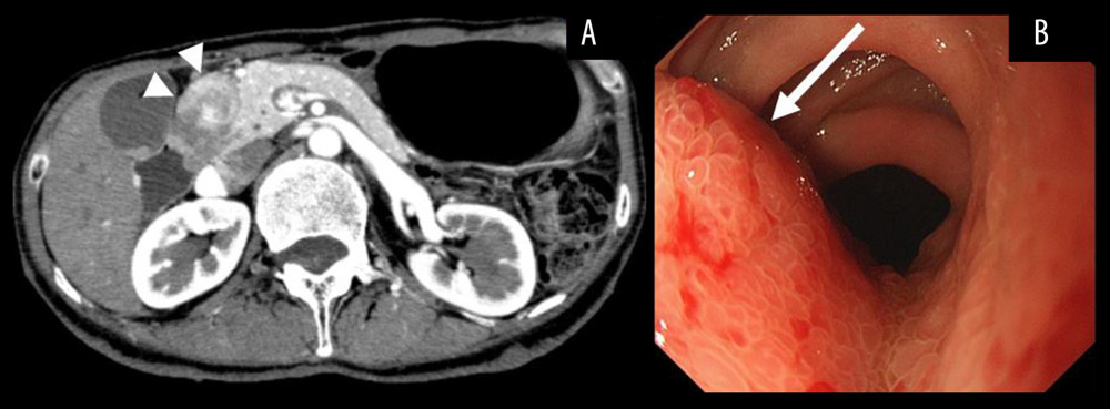 A contrast-enhanced abdominal computed tomography showing that the duodenal tumor was a 4-cm mass-like wall thickening centered on the submucosa (arrowhead) (A). Gastroduodenoscopy revealed a partially stenosed irregular mass in the postbulbous area of the duodenum (arrow) (B).