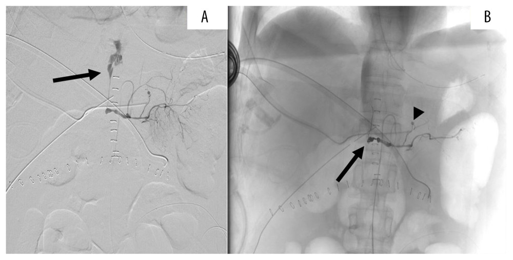 Angiography showing the bleeding point at the stump of the gastroduodenal artery (arrow) (A). Postembolization angiography showing successful embolization (arrow). Additionally, another aneurysm is seen in the posterior gastric artery (arrowhead) (B).